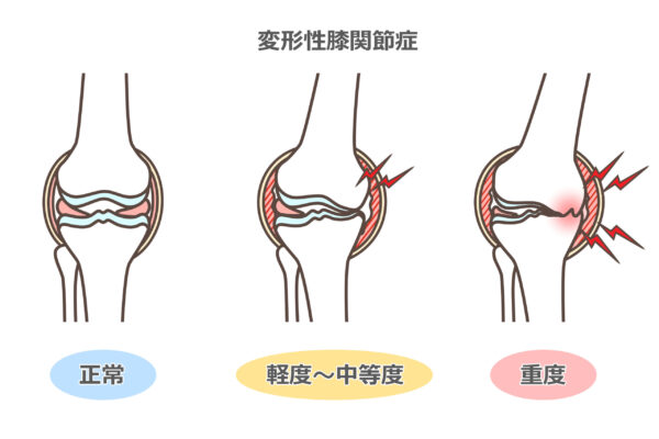変形性膝関節症の悪化の経緯の図解