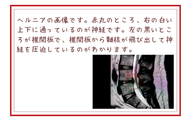 ヘルニアの画像です。赤丸のところ、右の白い上下に通っているのが神経です。左の黒いところが椎間板で、椎間板から髄核が飛び出して神経を圧迫しているのがわかります。