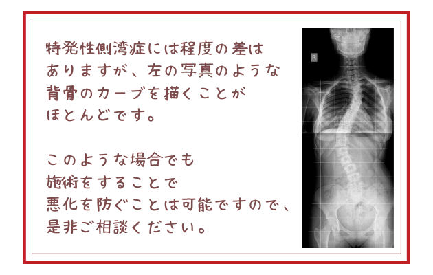 特発性側湾症には程度の差はありますが、左の写真のような背骨のカーブを描くことがほとんどです。 このような場合でも施術をすることで悪化を防ぐことは可能ですので、是非ご相談ください。