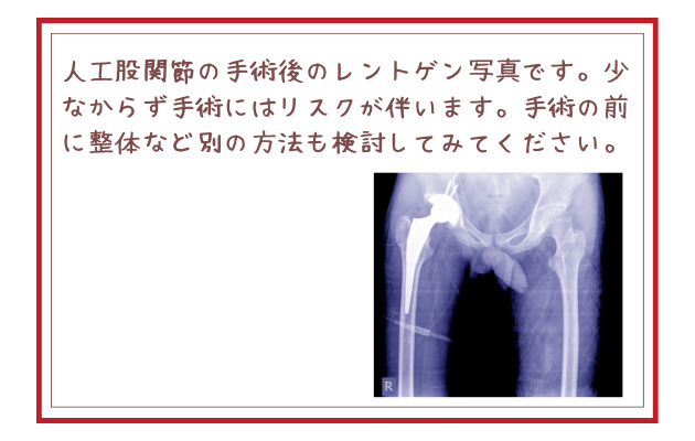 人工股関節の手術後のレントゲン写真です。少なからず手術にはリスクが伴います。手術の前に整体など別の方法も検討してみてください。